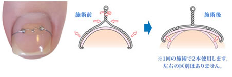 巻き爪、陥入爪 白崎医院 皮膚科専門医 高岡