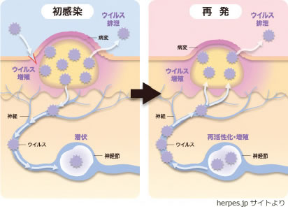 性器ヘルペス 男性の皮膚病 白崎医院 高岡市